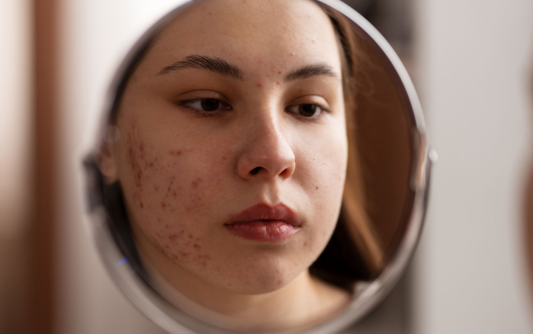Acne in adolescence
